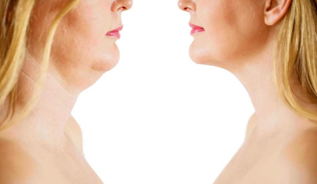 Double Chin treatment Sale before and after results