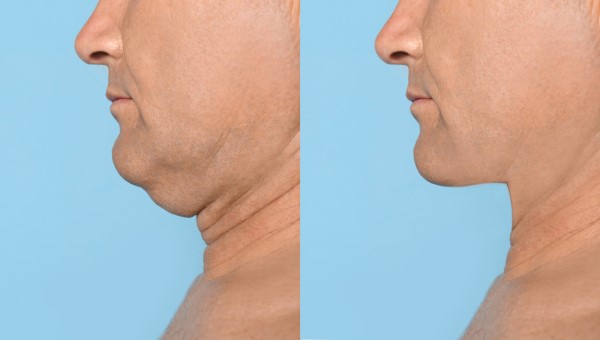 Which Non-Surgical Treatments Work Best for Jowls and Loose Skin Sale?