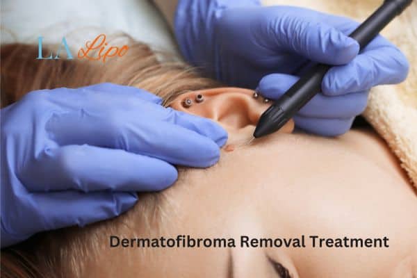 Dermatofibroma Removal Treatment Sale