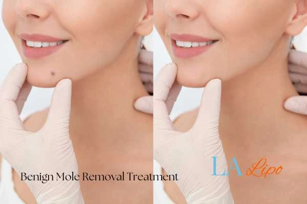 woman's before and after mole removal Sale results