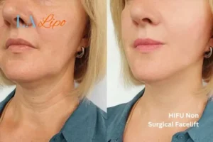hi-fu for wrinkles Sale before and after results