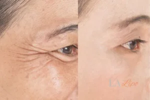 Before and after results of woman - HI-fu wrinkles reduction treatment Sale