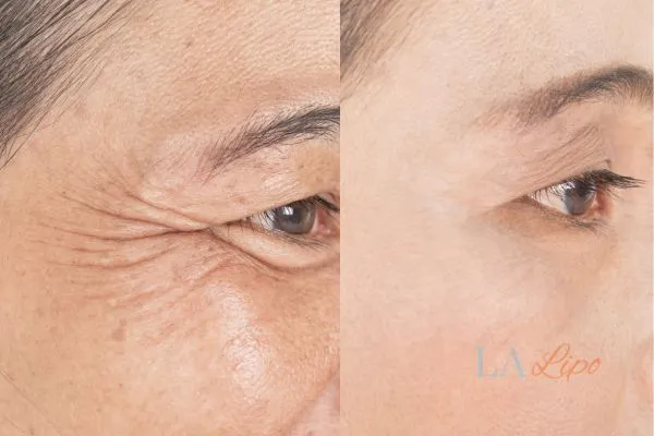 Before and after results of woman - HI-fu wrinkles reduction treatment Sale