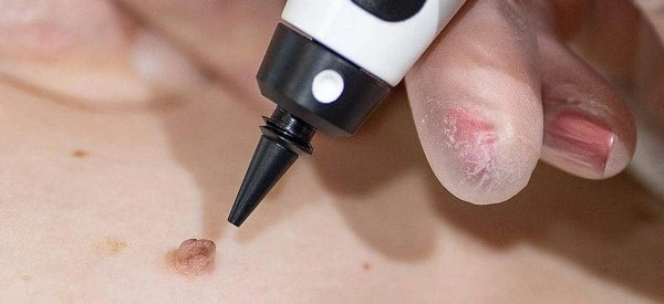 skin tag removal using cryopen Sale