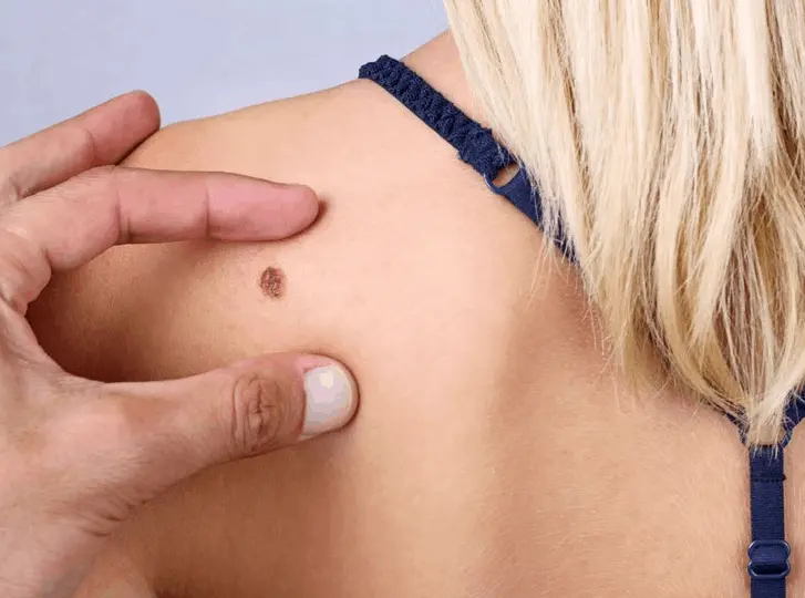 woman having mole removal Sale consultation before treatment.
