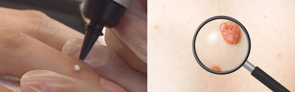 CryoPen practitioner Sale assessing a benign mole before treatment