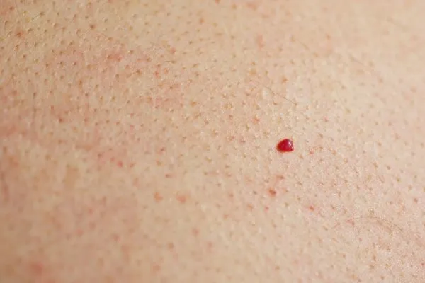 close up of a cherry angioma Sale