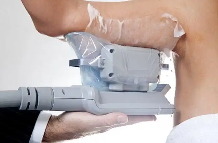 Picture of fat freezing Sale on the upper arms.