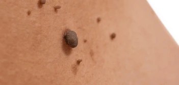 image of a skin tag Sale