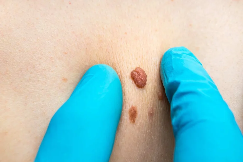 Consultant examining a skin tag Sale