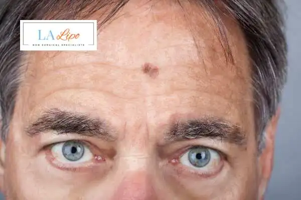 Solar Lentigo Removal Sale image of man with mark on his forehead
