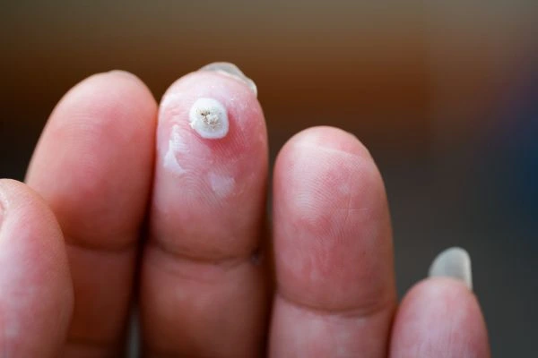 wart on person finger - cryotherapy to treat from LA LIPO Sale
