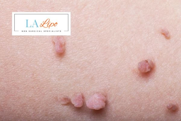 Does cryopen skin tag removal Sale hurt? Find out now call our team today!