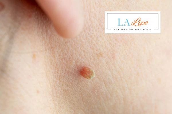 Book skin tag removal Sale today speak to our team now!