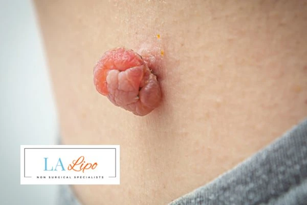 Interested in skin tag removal Sale? Concerned about the pain? Find out more today!