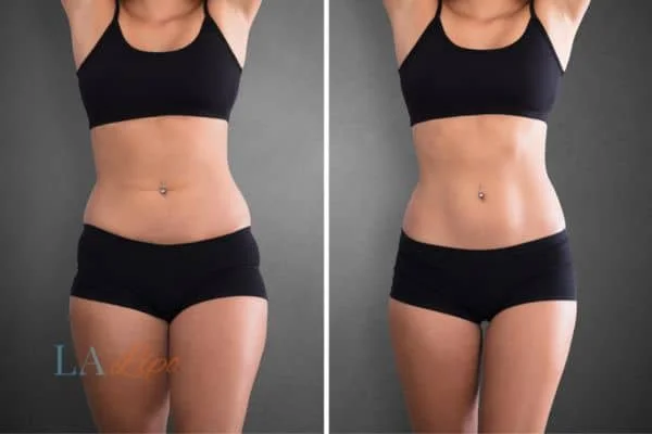 before and after results of non-surgical treatment to help a woman's body image and mental health Sale
