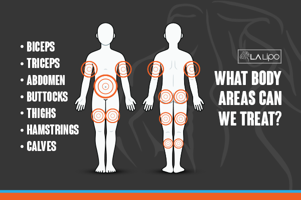 Diagram to show areas you can have LA-EMS Body Sculpting Treatment Sale