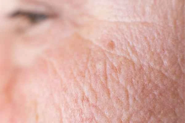 close up picture of a woman's face showing an age spot Sale