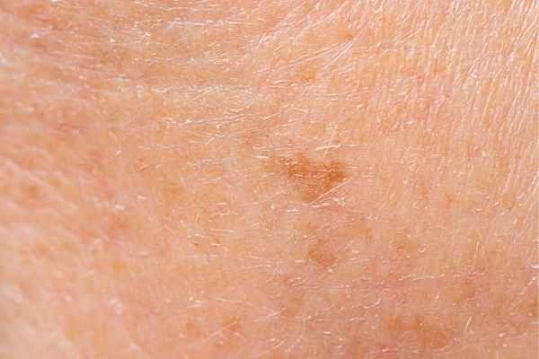 close up picture of age spots Sale