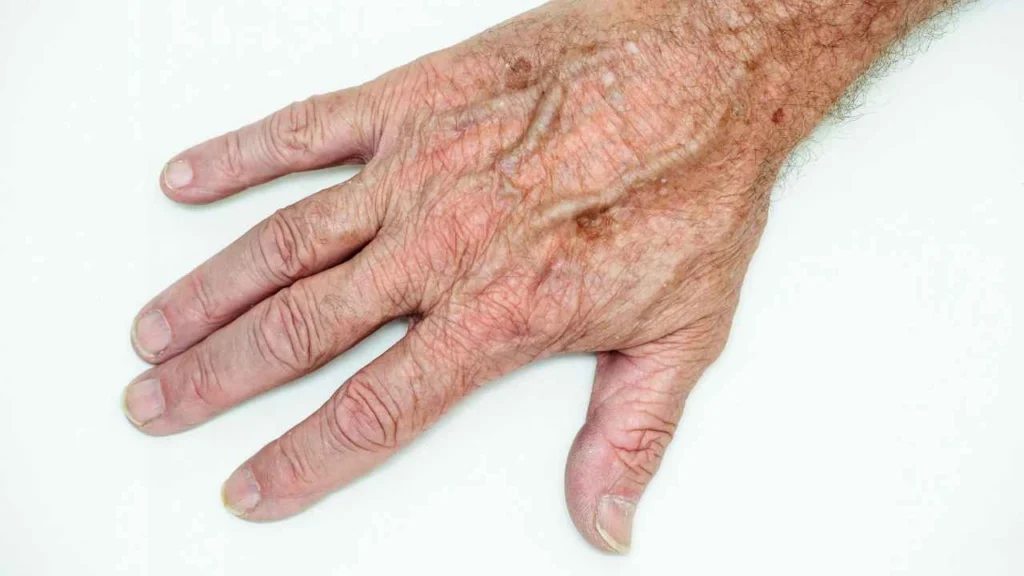 Male hand showing age spot Sale