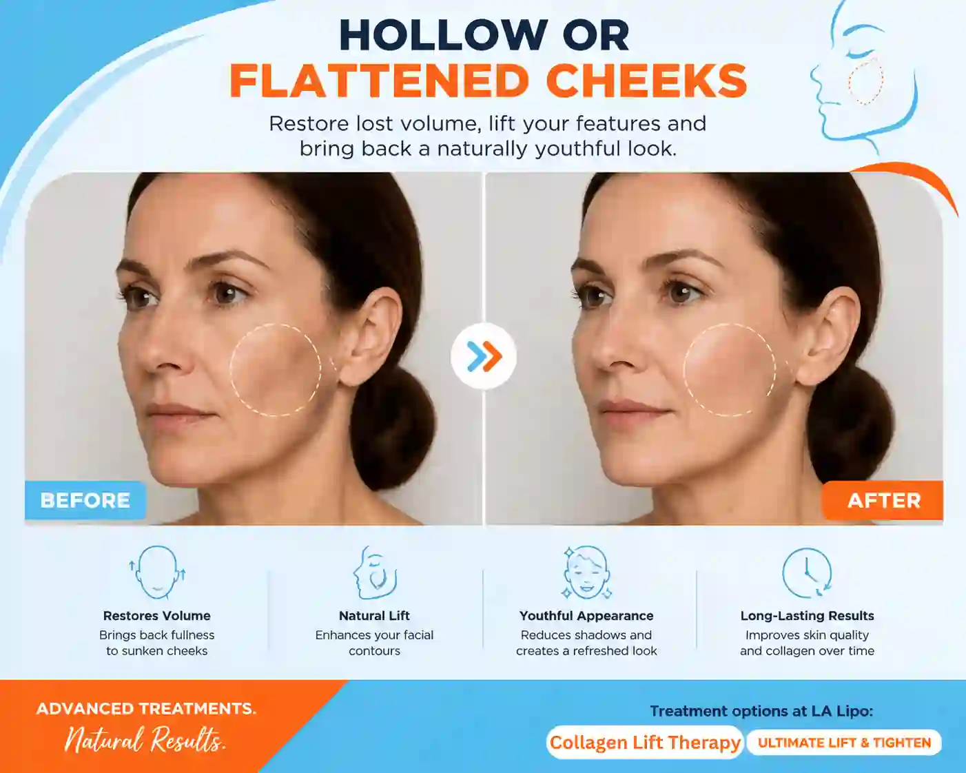 Sign #4: Hollow or Flattened Cheeks Sale